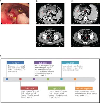 Clinical course and management of insidious adrenal crisis manifested initially as hyperpyrexia secondary to pembrolizumab: Case reports and literature review